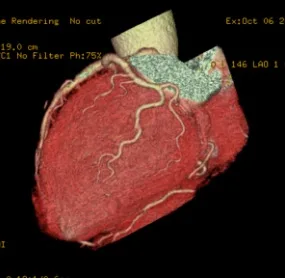 心臓冠動脈CT画像