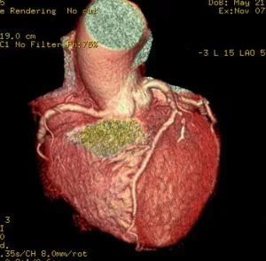 心臓CT画像