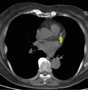 簡易心臓CT画像