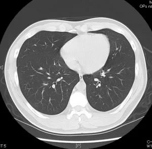 肺のCT画像１