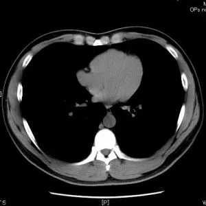 肺のCT画像２